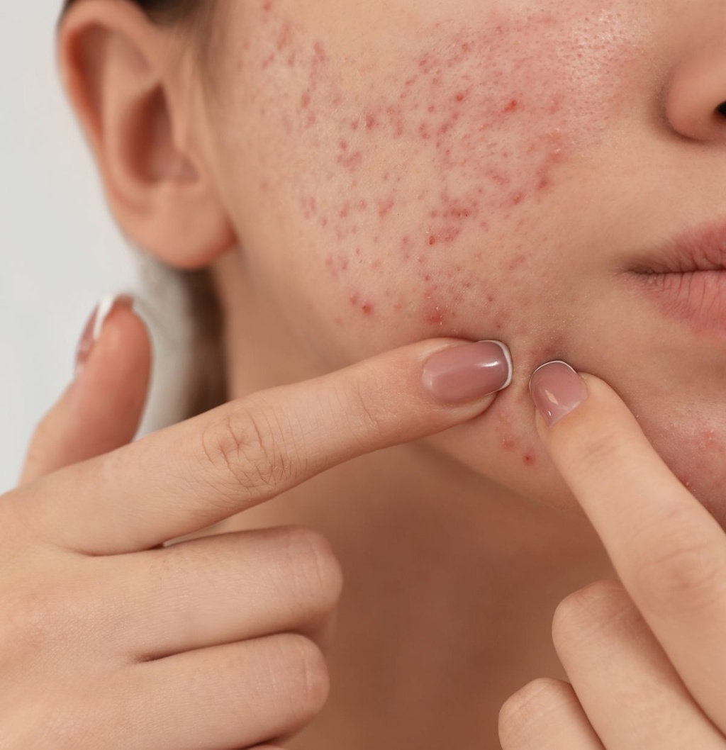 Acne Control Treatment